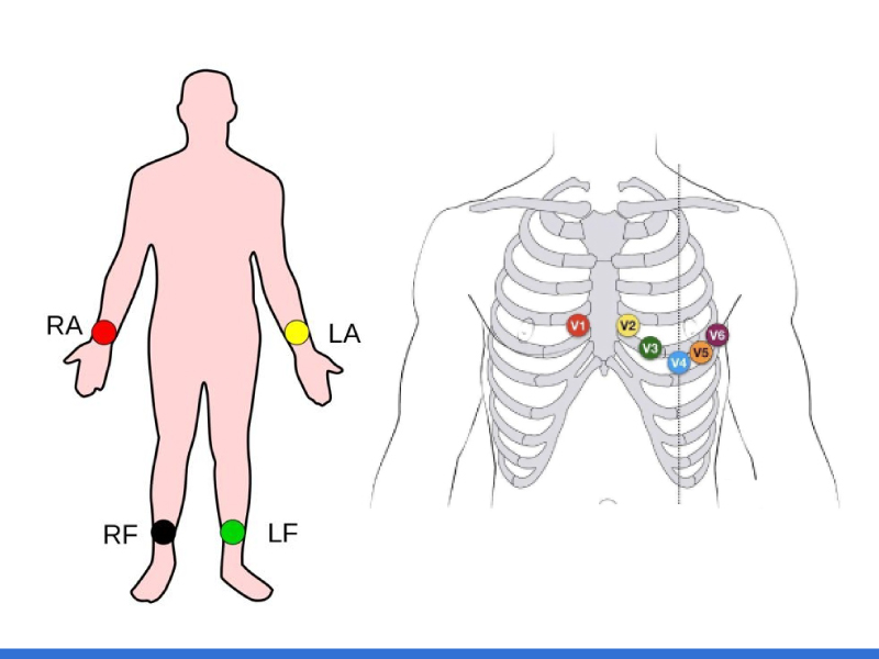 Componentes clave de colocación del electrodo ECG