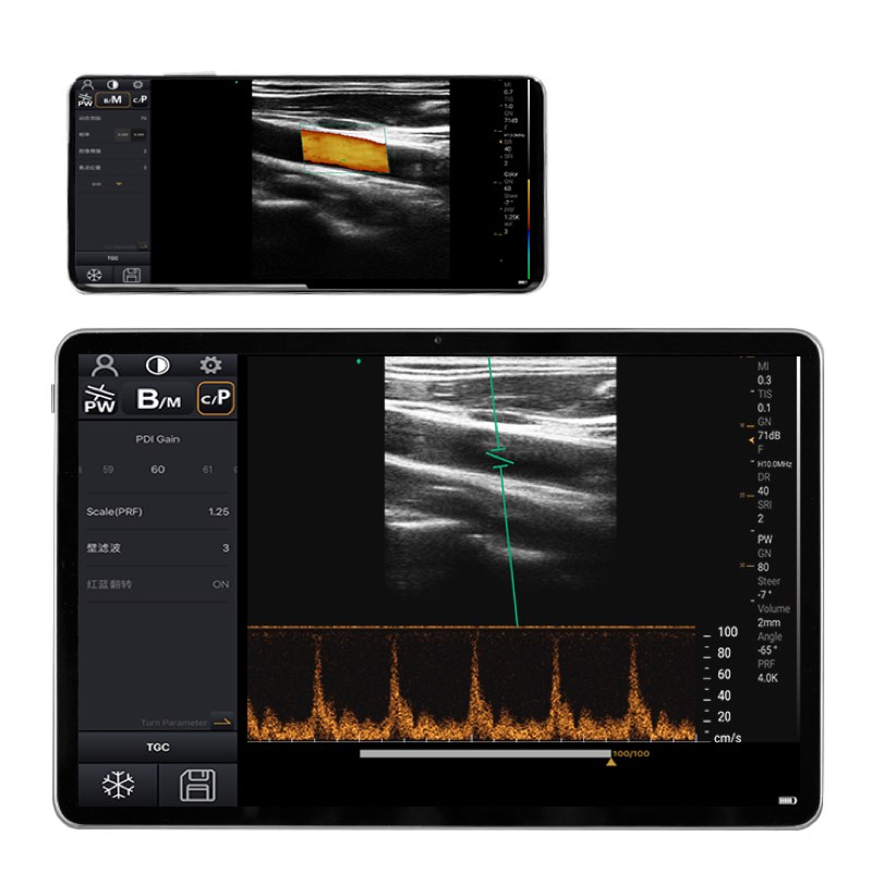 Sonda de ultrasonido portátil inalámbrica